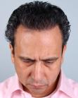 After Hair Transplant&nbsp;Front